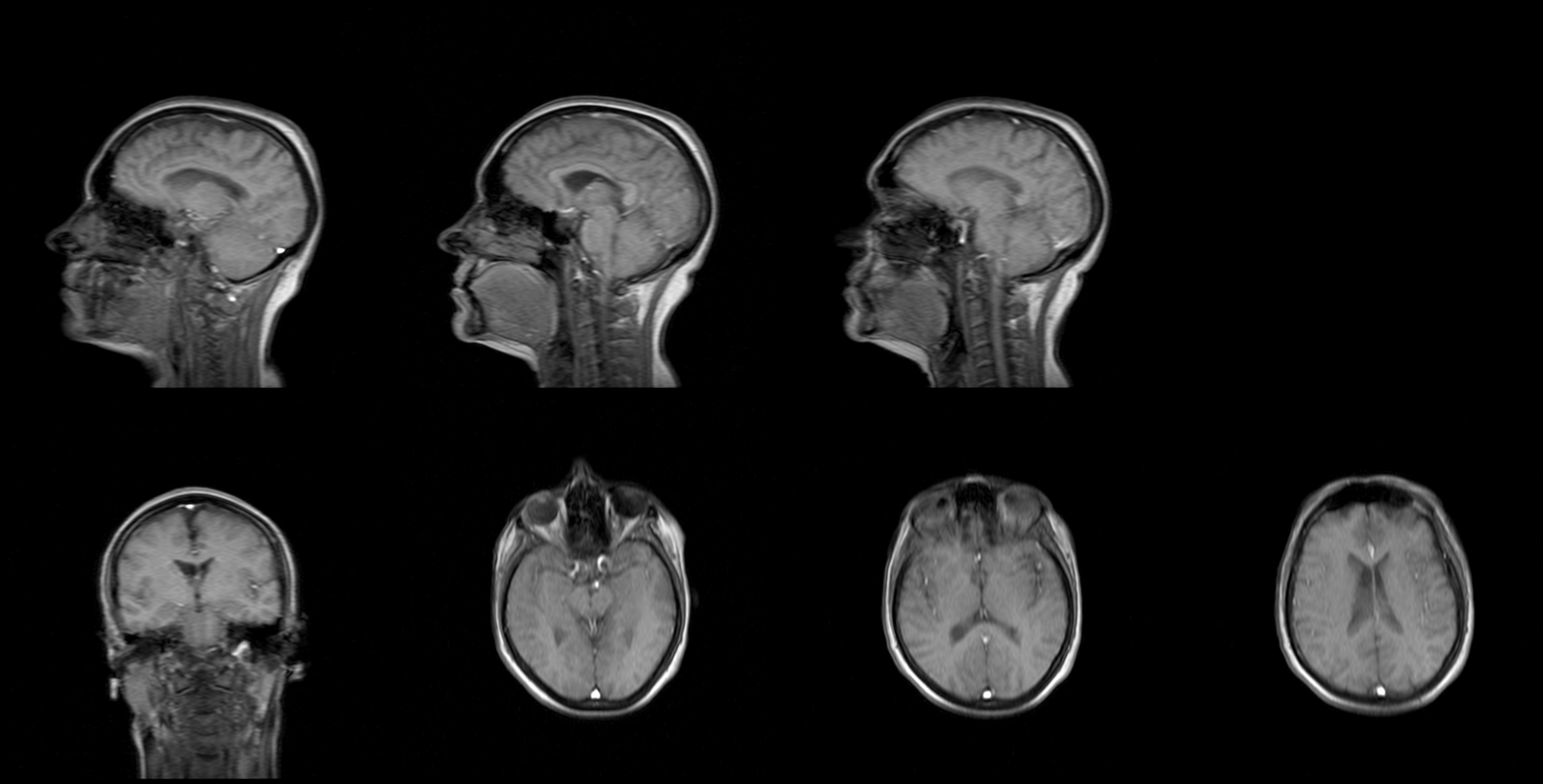 MRI images of the brain